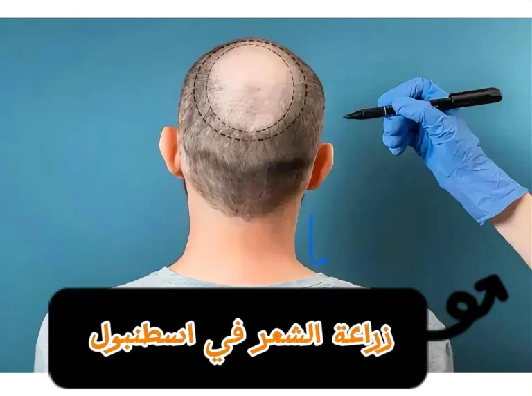 زراعة الشعر في إسطنبول دليل كامل